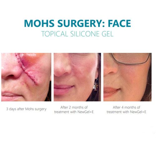 NewGel+ E Silicone Gel with Vitamin E Before & After Photo Showing Mohs Surgery Scars on the Face