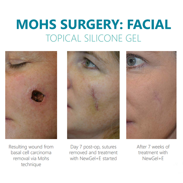 Do Silicone Scar Sheets Work On Hyperpigmentation Eveline Ziegler